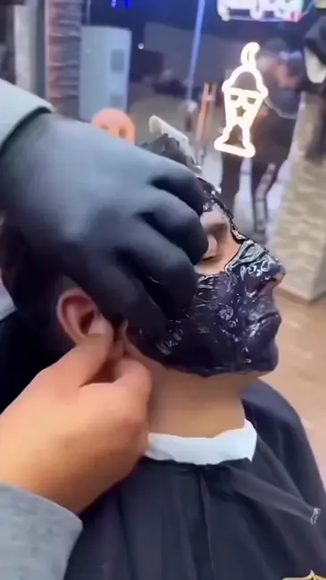 Facial Peel video thumbnail